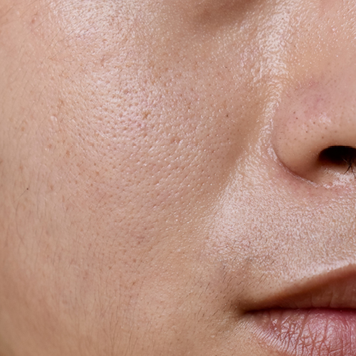 Gros plan d’une zone nasolabiale grasse