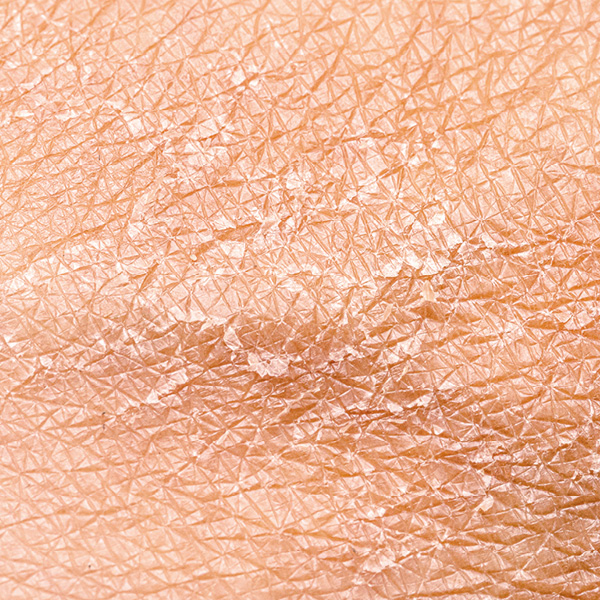 [Translate to Niederländisch:] Foto von sehr trockener Haut