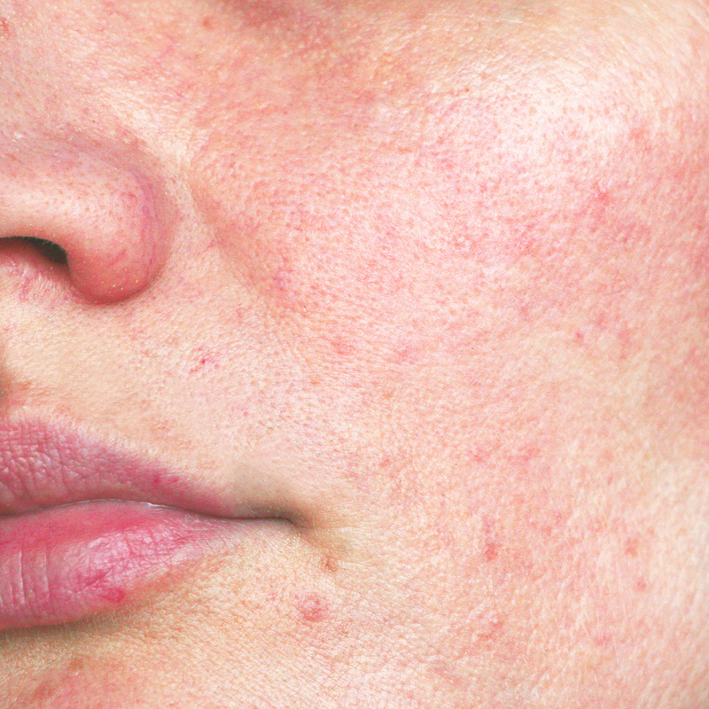 Reddened skin on the cheek