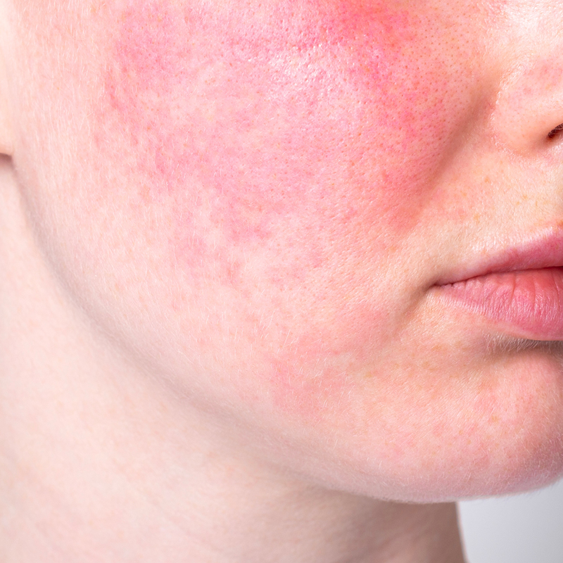 Severely reddened skin (rosacea) on the cheek