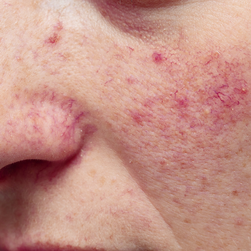 Dilated blood vessels (telangiectasia) on the cheek
