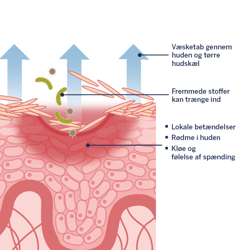 Hudgrafik Atopisk hud