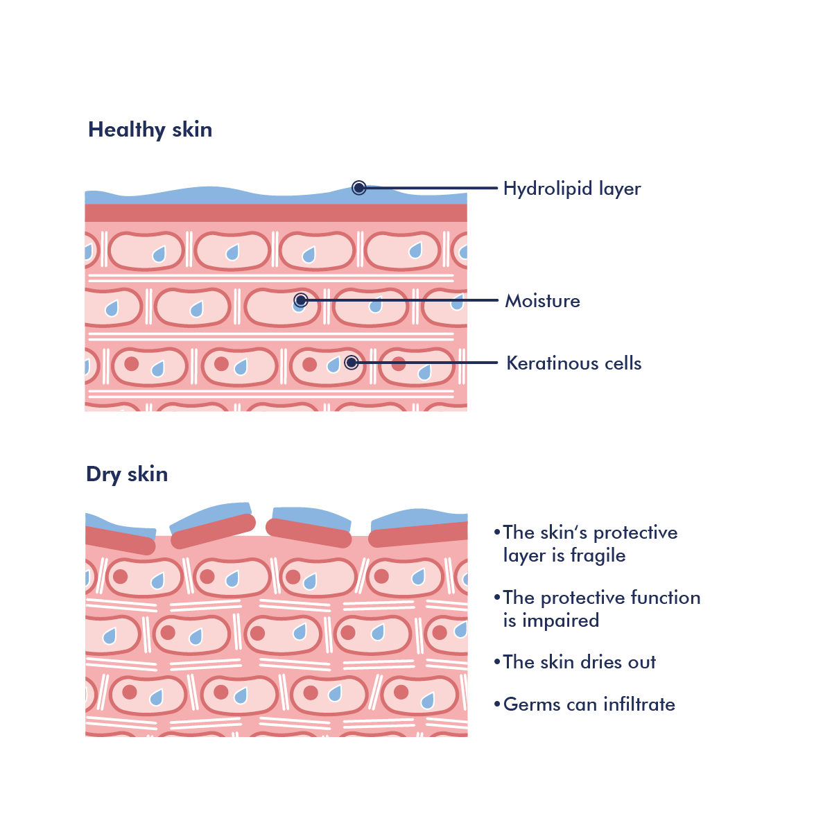 Illustration of dry skin