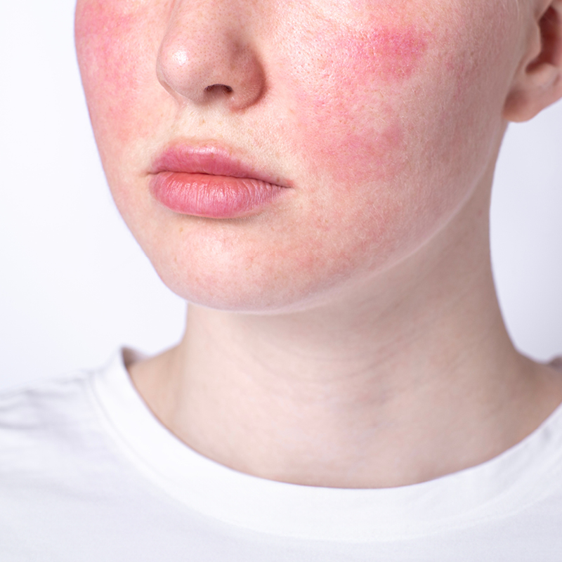 Foto van rosacea op de wang