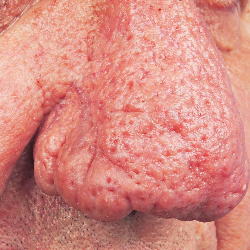 Foto van ernstige woekeringen op de neus (rhinophyma) bij rosacea