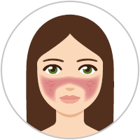 Graphic: Woman with rosacea subtype 1 (rosacea erythematotelangiectatica).