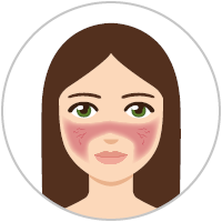 Grafica: Donna con rosacea di sottotipo 1 (rosacea eritematotelangiectatica)