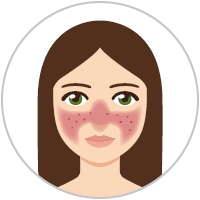 Graphic: Woman with rosacea subtype 2 (rosacea papulopustulosa)