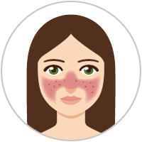 Grafica: Donna con rosacea di sottotipo 2 (rosacea papulopustolosa)