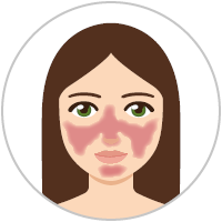 Graphic: Woman with rosacea subtype 3 (phymatous type rosacea)