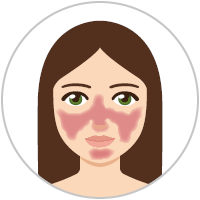 Grafica: Donna con rosacea di sottotipo 3 (rosacea di tipo phymatous)