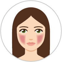 Graphic: Woman with early stage rosacea