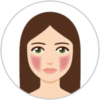 Grafica: Donna con rosacea in fase preliminare