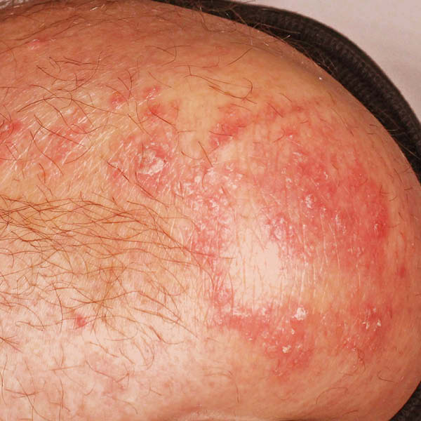 Foto van psoriasis (psoriasis vulgaris) op de elleboog
