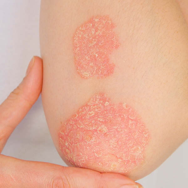 Foto van psoriasis (psoriasis vulgaris) op de elleboog
