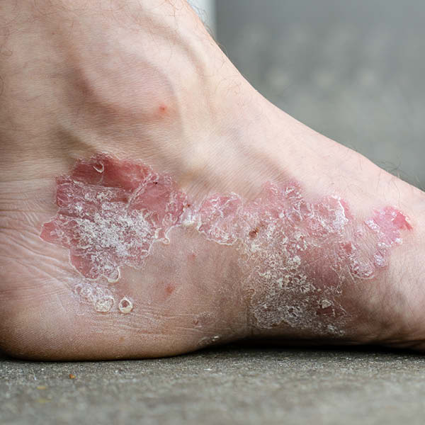 Foto van psoriasis (psoriasis vulgaris) op de voet