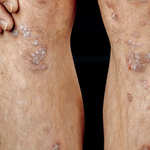 Foto van psoriasis (psoriasis vulgaris) op knie en scheenbeen