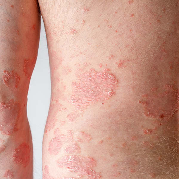 Foto van psoriasis (psoriasis vulgaris) op de onderrug
