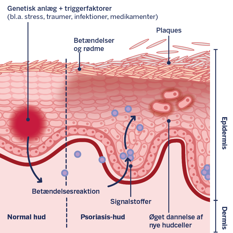 Grafisk fremstilling af processerne i psoriasishuden