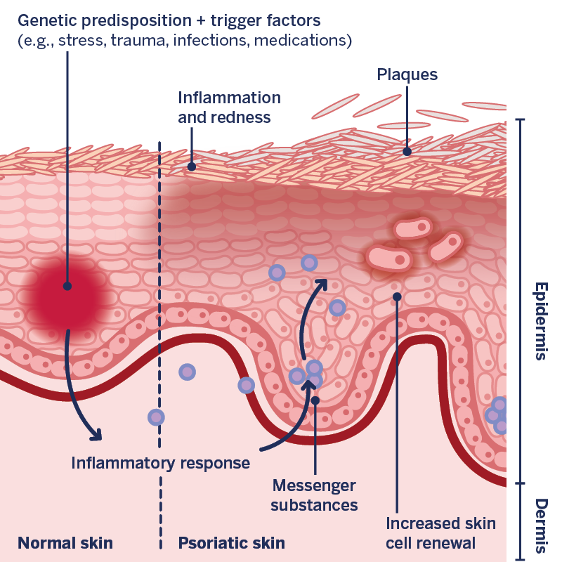 Graphic representation of the processes within psoriatic skin