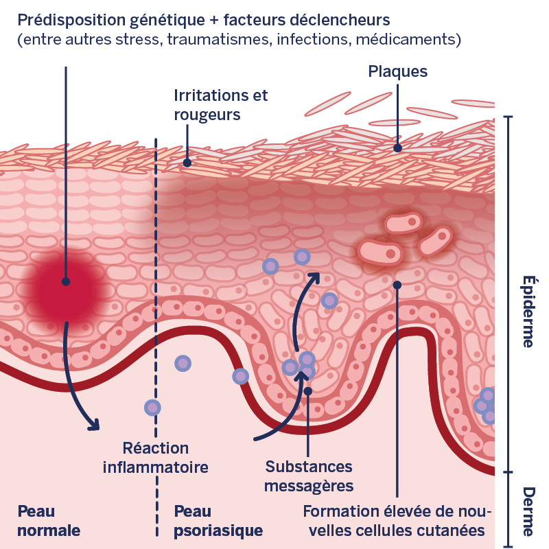 Représentation graphique des processus dans la peau psoriasique