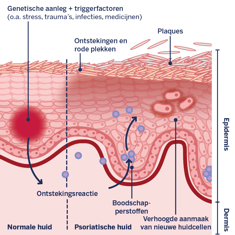 Grafische weergave van de processen in de psoriatische huid