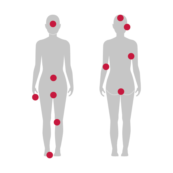 Silhouet van een mens bij wie de veel voorkomende lichaamsgedeeltes met rood zijn gemarkeerd.