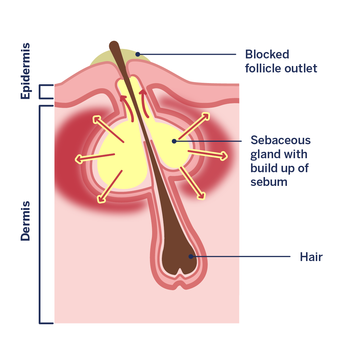 Infographic: Formation of a pimple