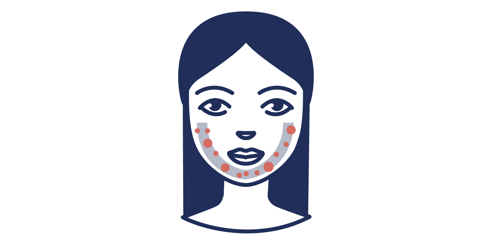 [Translate to Englisch:] Illustration der Acne tarda in der U-Zone