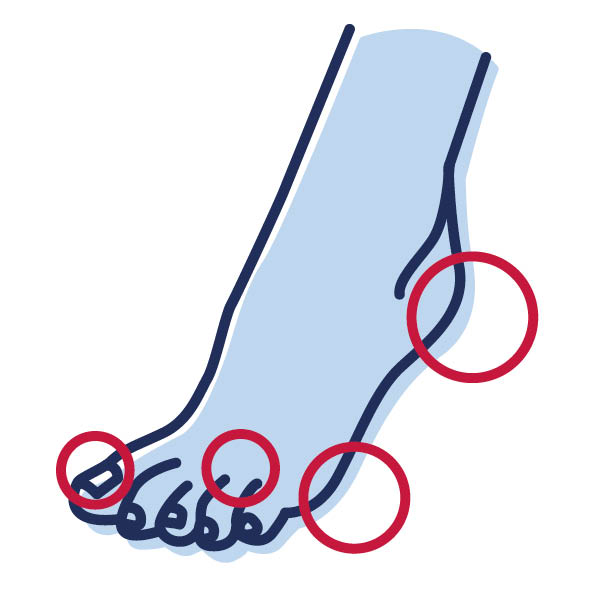 [Translate to Niederländisch:] Zeichnung von einem Fuß, bei der Problemzonen markiert sind