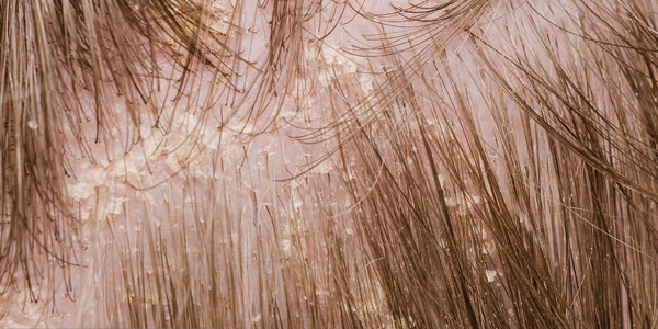 Cuoio capelluto con forfora grassa Cuoio capelluto con forfora grassa