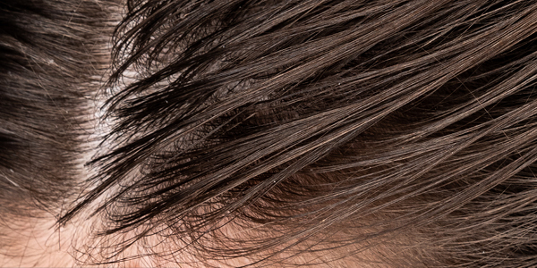 Cuoio capelluto con capelli grassi Cuoio capelluto con capelli grassi