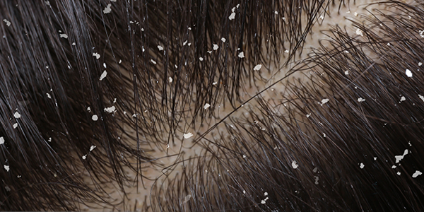 Cuoio capelluto con forfora secca Cuoio capelluto con forfora secca