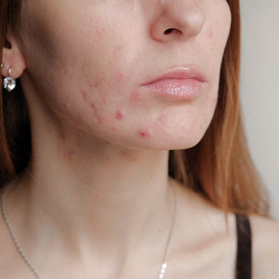 Acne tarda op de kin