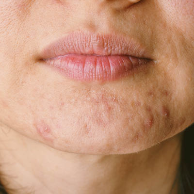 Acne tarda op de kin