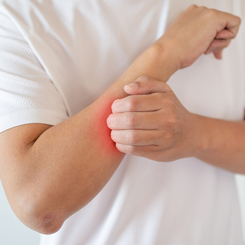 Persoon krabt zich aan de onderarm