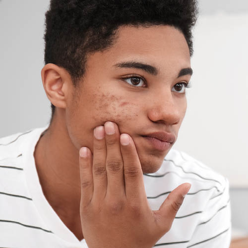 Een tiener bekijkt zijn acne in de spiegel