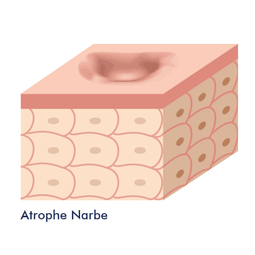 Grafische weergave van een atrofisch litteken
