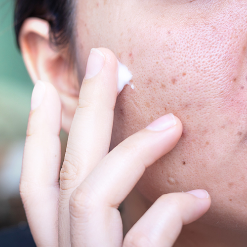 Vrouw verzorgt huid met puistvlekjes