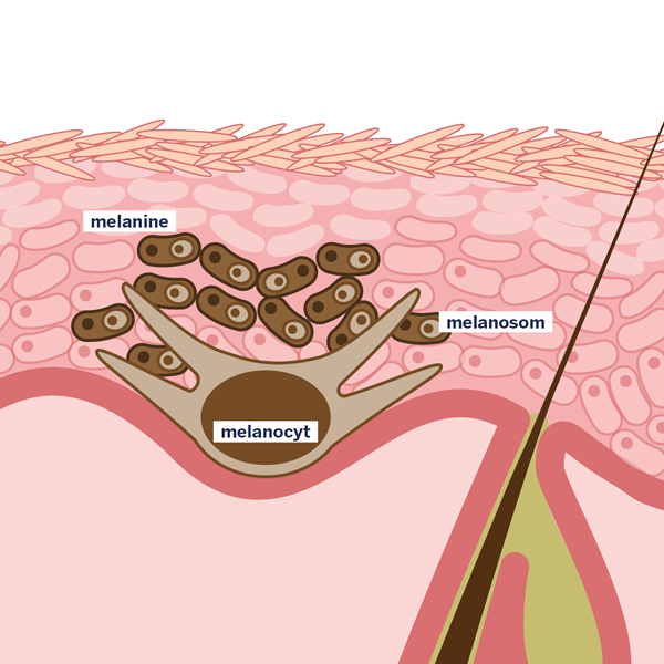 post-inflammatoire hyperpigmentaties