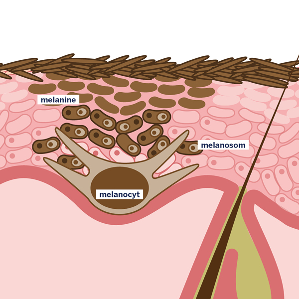 post-inflammatoire hyperpigmentaties