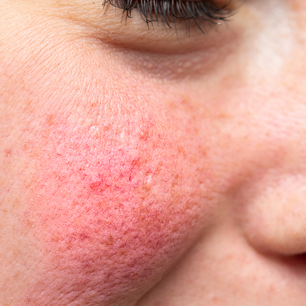 Foto van de huidziekte rosacea