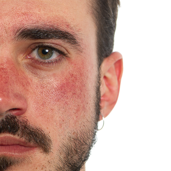Afbeelding van een neus met rosacea