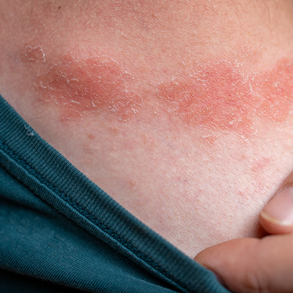 Foto van psoriasis op de huid