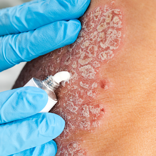 Er wordt een crème op de psoriasis gesmeerd