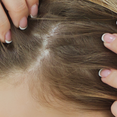 Seborroeïsch eczeem kan voorkomen op de hoofdhuid Haarscheiding