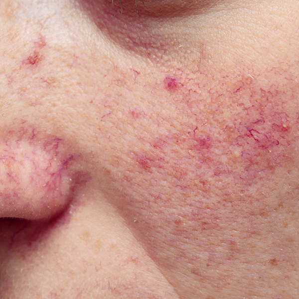 Foto van capillaire teleangiëctasieën
