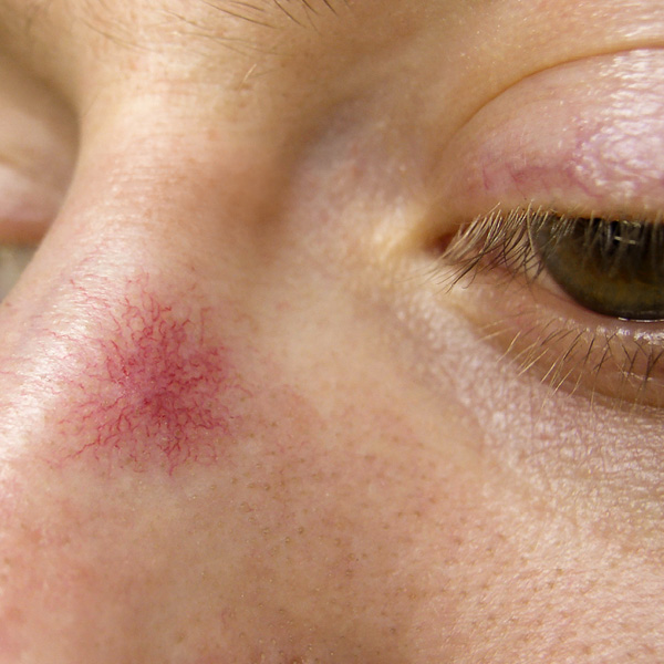 Foto van Spider naevus