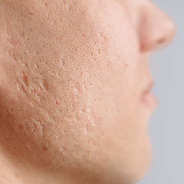 Wang met acnelittekens