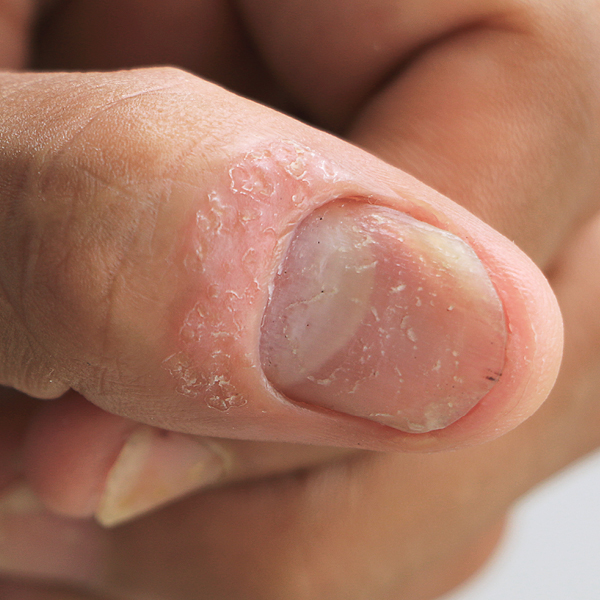 Een vorm van nagelpsoriasis aan de vinger